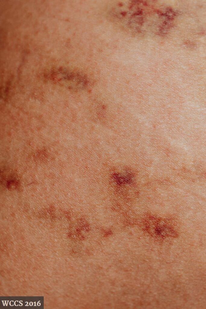 motivos de un eczema