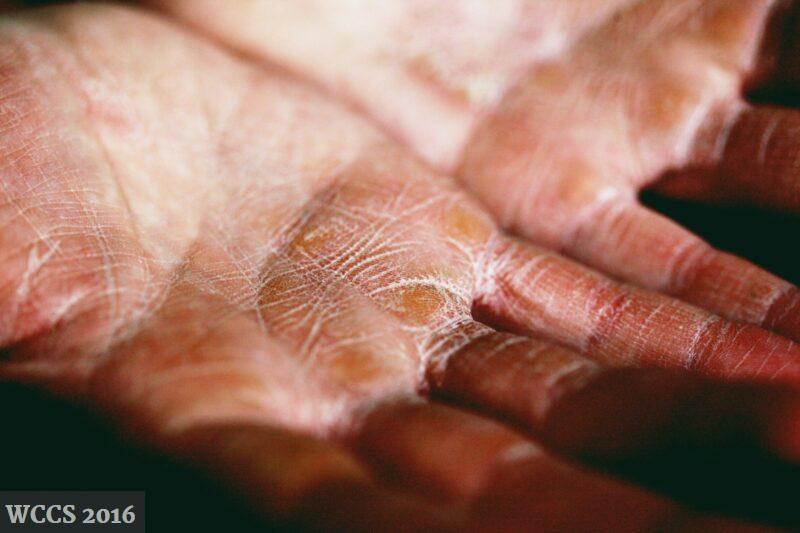 Posibles motivos de un eczema featured image