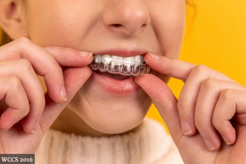 Ortodoncia invisible vs brackets: qué opción 