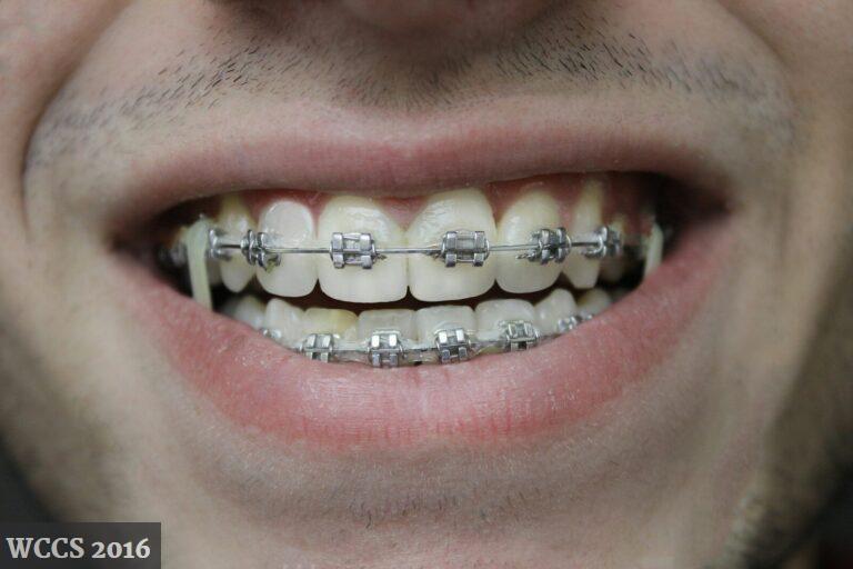 Ortodoncia invisible vs brackets: qué opción compensa